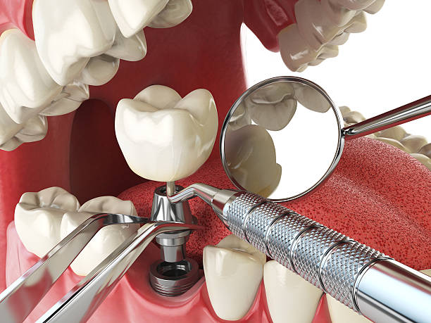 Best Emergency Dentist for Lost Fillings or Crowns in Kemp, TX